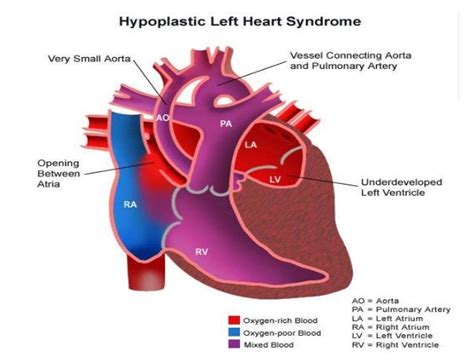 ventricular outflow tract obstruction diagnosis